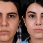 endoscopic vs traditional brow lift