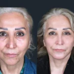 Deep Plane Facelift in Dubai