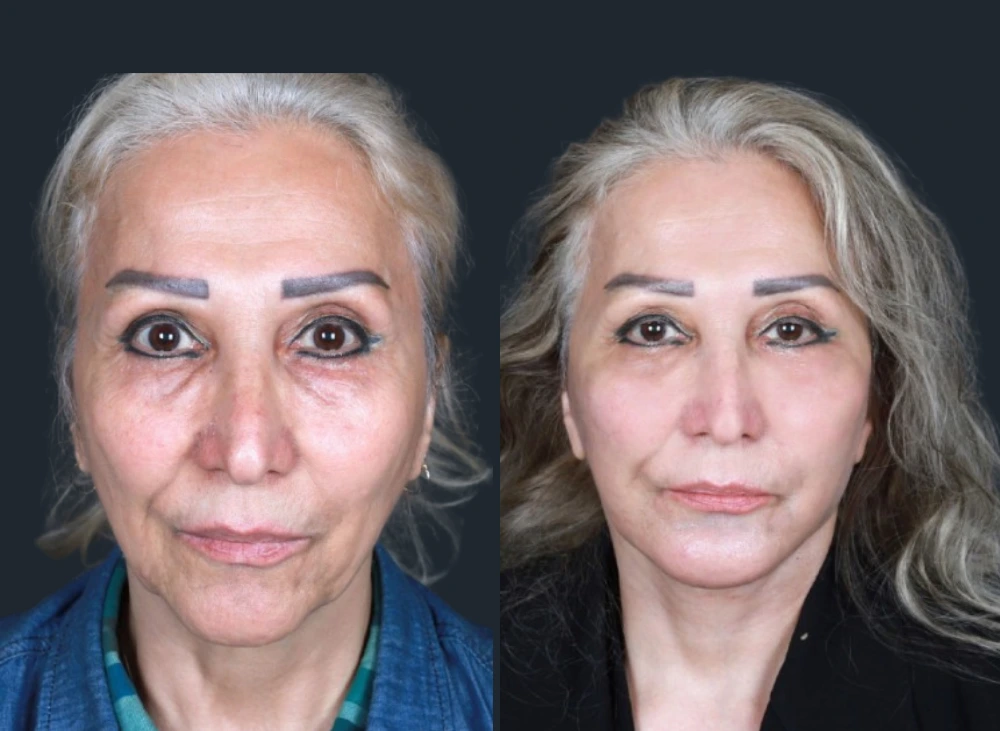 Deep Plane Facelift in Dubai