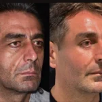 Full Face Fat Transfer