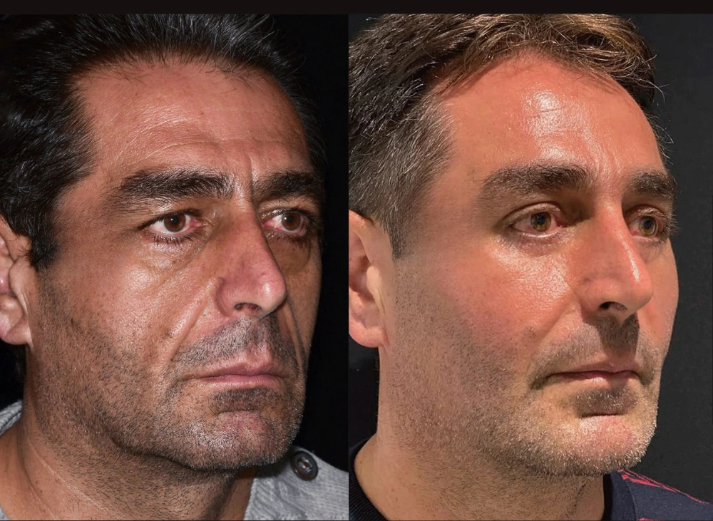 Full Face Fat Transfer