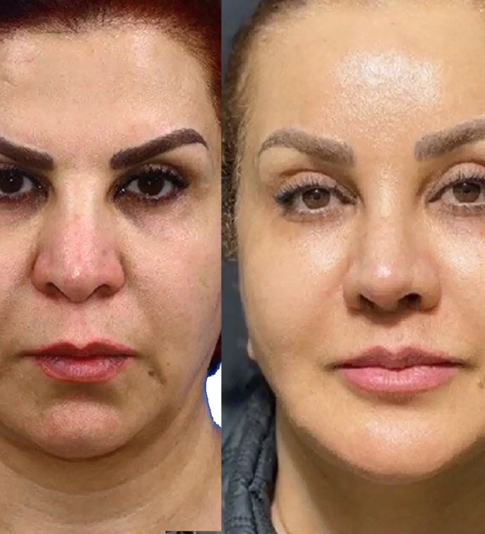 face lift by Dr Kamran Asadi Blue angel poly clinic Dubai