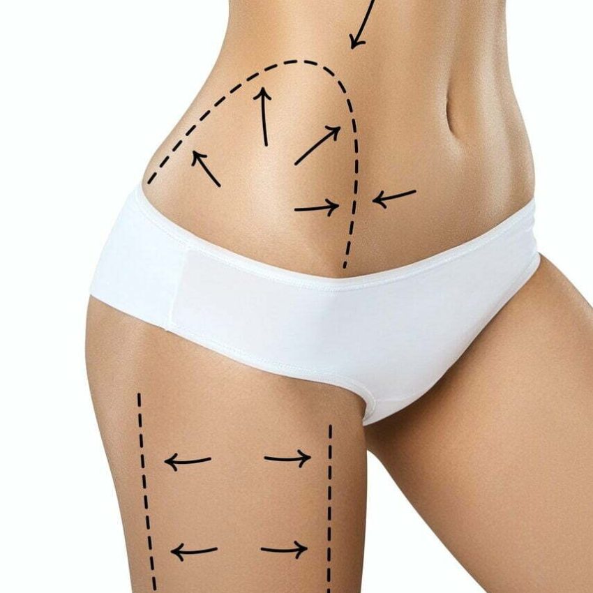 Woman torso in underwear with medical marks for plastic surgery or liposuction Woman torso in underwear with medical marks for plastic surgery or liposuction